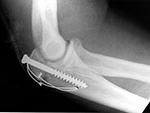 Tension band wire olecranon fracture