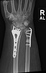 Ulnar hook locking plate