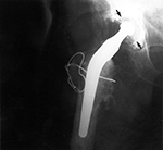 Broken trochanteric osteotomy wire