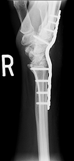 Wrist arthrodesis with low contact dynamic compression plate