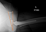 Hip arthroplasty evaluation