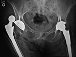 Bilateral hip arthroplasty; right hip arthroplasty dislocation