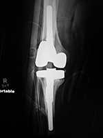 Biomet Vanguard 360 knee revision