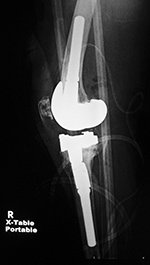 Biomet Vanguard 360 knee revision