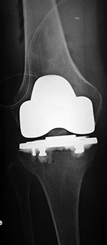 Bicruciate retaining TKA
