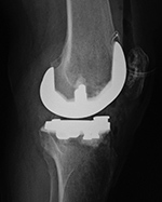 Bicruciate retaining TKA