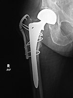 Bipolar hemiarthrplasty with claw plate and cables