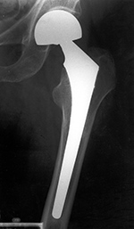 Bipolar hemiarthroplasty