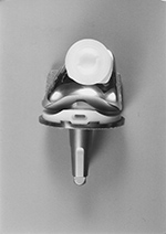 Contemporary TKA with UHMWPE components