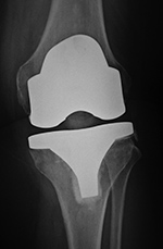 Cruciate retaining TKA
