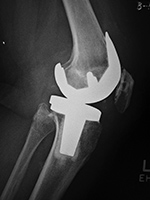 Cruciate retaining TKA