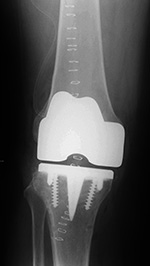 Cruciate retaining total knee prosthesis AP view
