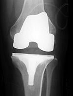 Cruciate substituting knee prosthesis - AP view