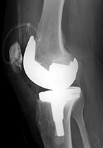 Cruciate substituting knee prosthesis - latera view 