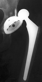 Dislocated hip arthroplasty