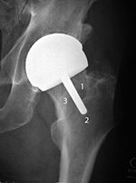 Femoral head resurfacing zones