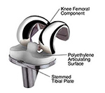 Fixed bearing knee prosthesis