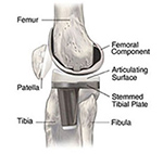 Fixed bearing knee prosthesis