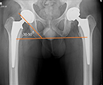 Hip arthroplasty evaluation
