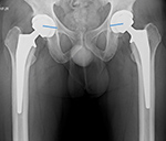 Hip arthroplasty evaluation