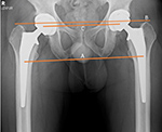 Hip arthroplasty evaluation