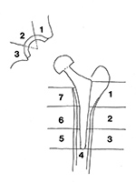 Hip arthroplasty zones