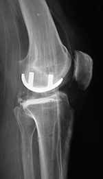Lateral unicompartmental knee prosthesis