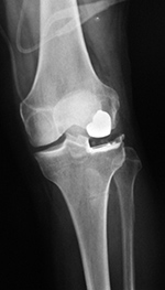 Lateral unicompartmental knee prosthesis