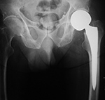 Left hip bipolar hemiarthroplasty