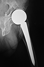 Bipolar left hip hemiarthroplasty
