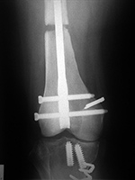 Cadaver allograft