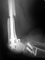 Cadaver allograft