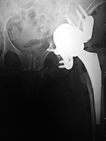 Triflange left hip revision arthroplasty