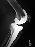 Left knee cruciate substituting revision total knee arthroplasty