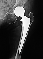 Modular endoprosthesis