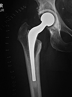 Prostalac hip replacement