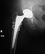Right hip total arthroplasty with cerclage wires