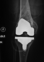 Stryker Triathlon total knee prosthesis