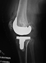 Stryker Triathlon total knee prosthesis