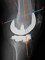 TKA evaluation lateral view