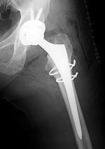 Total hip arthroplasty