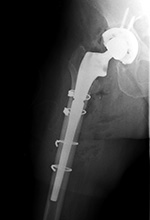 Total hip arthroplasty