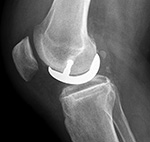 Unicompartment knee prosthesis