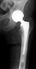 Unipolar hip prosthesis