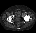 Small particle disease