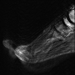 MRI motion artifact