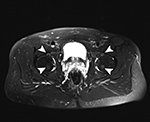 MRI pulsation artifact