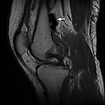 Susceptibility artifact
