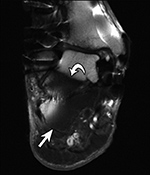 Failed fat suppression