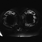 Inversion recovery imaging